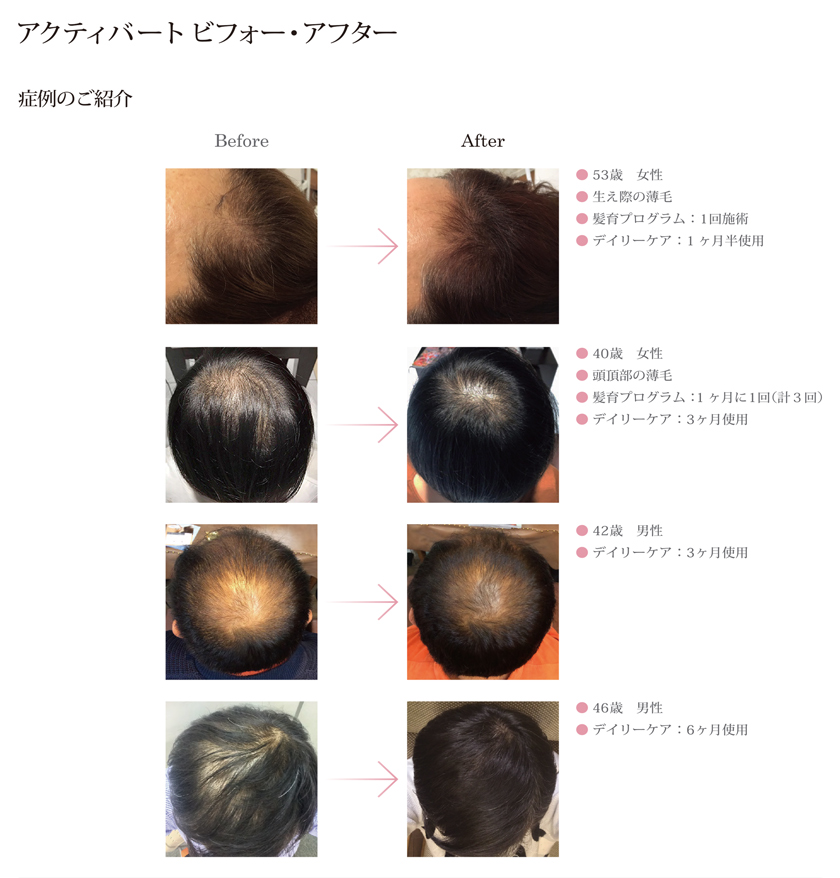 翌日発送可能】 アクティバート スカルプローション ヘアエッセンス